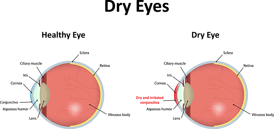 Chart Showing a Healthy Eye, Compared to One With Dry Eye