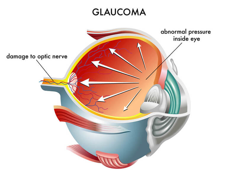 Glaucoma Eye Test Chart