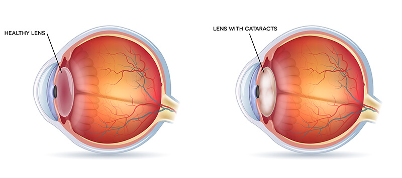 Chart Showing a Cataract in the Eye