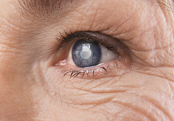 Closeup of a Cataract in the Eye