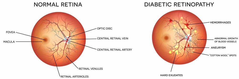 Diabetic Retinopathy Chart 