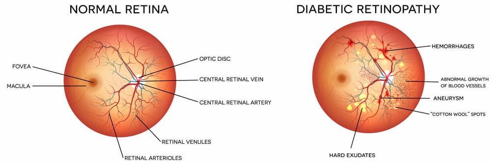 Retina Damage Chart