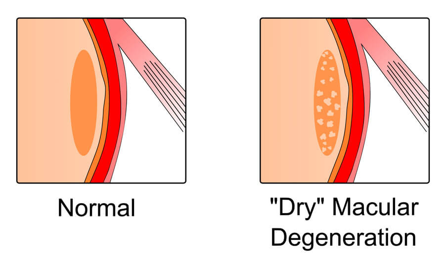 Dry AMD