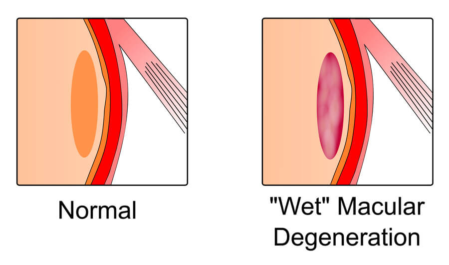 Wet AMD