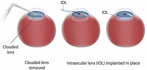 Cataract Surgery Chart