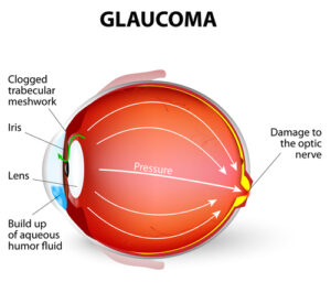 Glaucoma